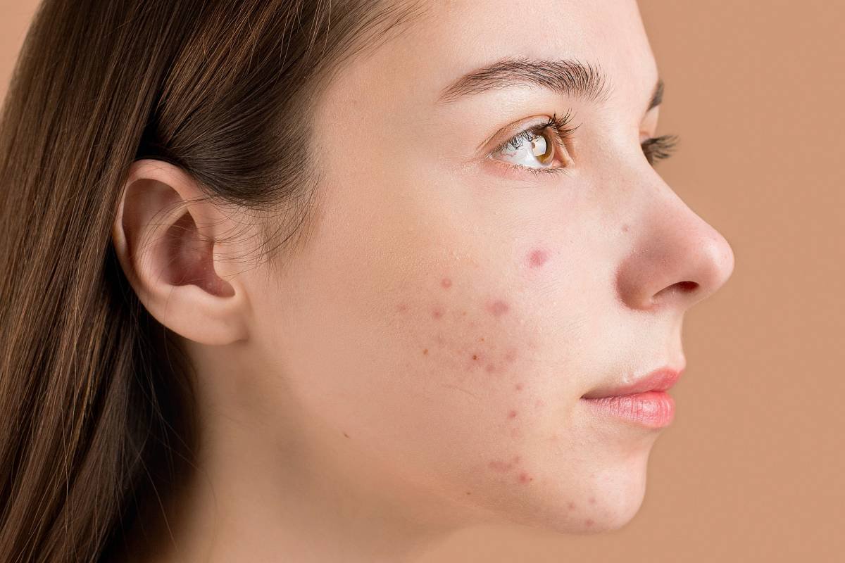 acne, zit, eczema, dry skin